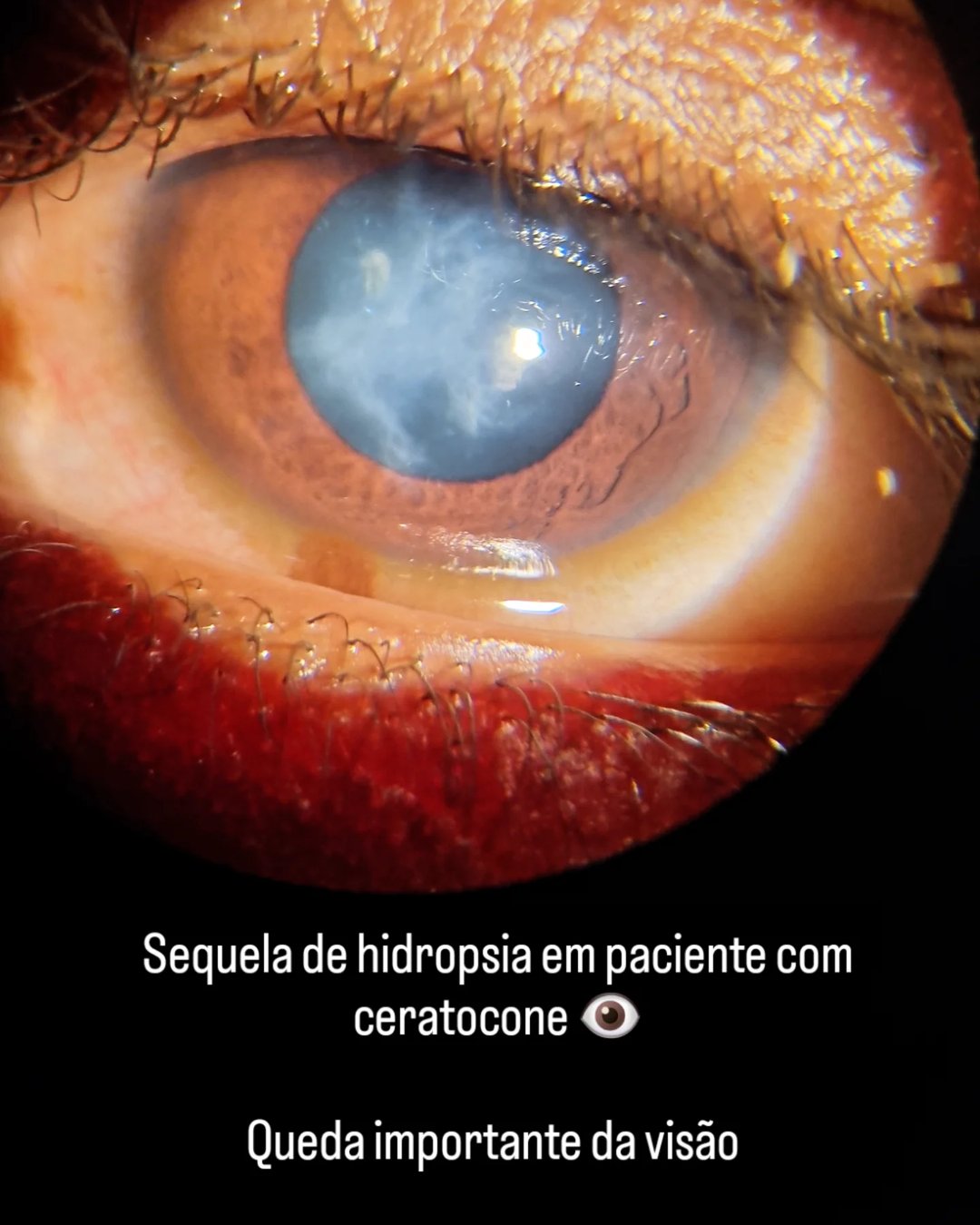Caso clínico — sequela de hidropsia em paciente com ceratocone · Dr. Vitor Tavares